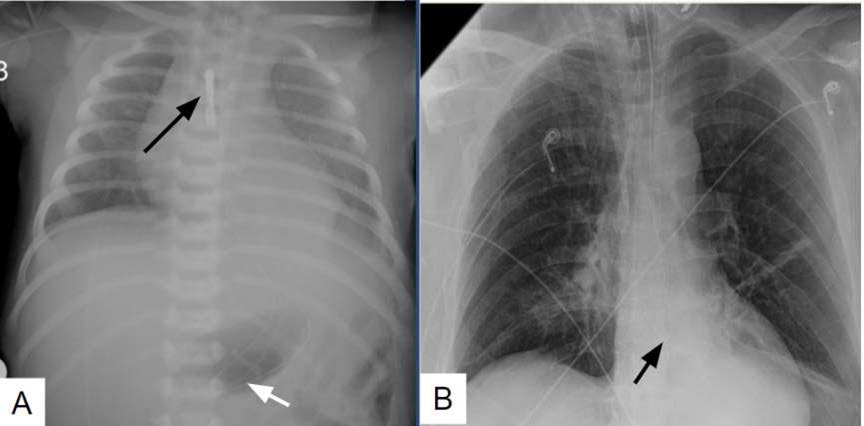 6-year-old male with esophageal misplacement. FINDINGS: ( A) Feeding tube is looped in the stomach ( white arrow) resulting in a tip within the upper esophagus (black arrow). In another patient (B) the enteric tube is seen above the diaphragm consistent with an esophageal misplacement (black arrows) TECHNIQUE: Anterior posterior chest radiographs of two patients. 56kV 200mA and 95kV 500mA respectively.