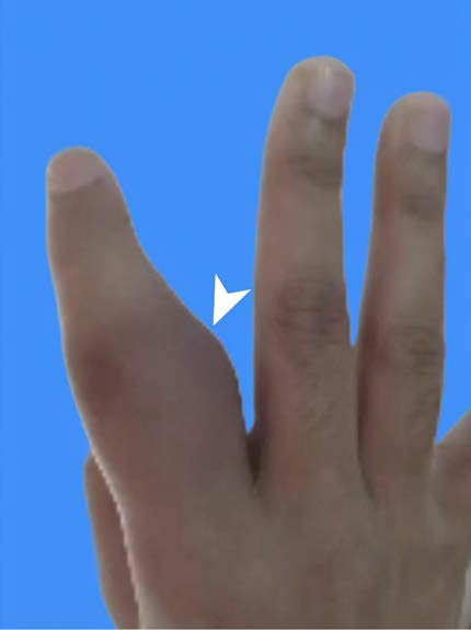 45-year-old female with fibro-osseous pseudotumor of the index finger. The clinical presentation of a bulging mass (arrowhead) is observed in the proximal ulnar part of the right hand’s index finger.