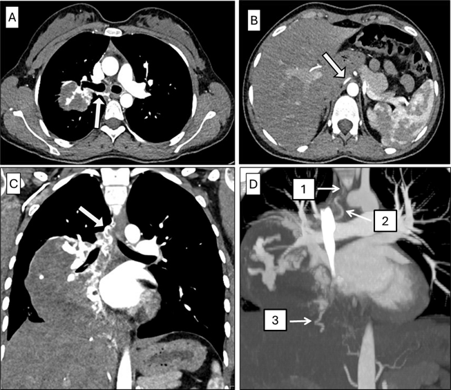 Multiple systemic arterial feeders to right lung choriocarcinoma metastasis