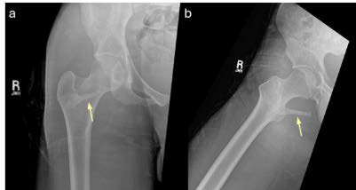 28 year old male with right sided pelvic digit.