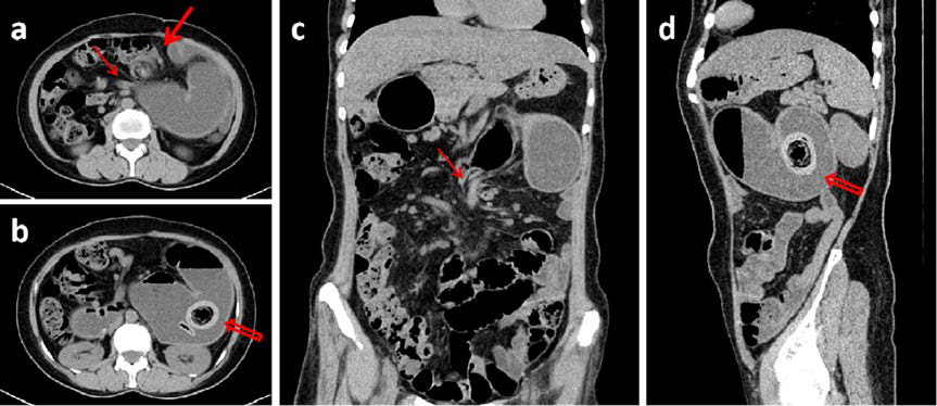 50-year-old female with internal hernia- CT. FINDINGS: CT scan shows a left paraduodenal hernia. Neck of the hernia sac (thin arrow) with adjacent fluid-filled dilated small bowel, and a “whirlpool-sign” signifying rotation and traction of the mesenteric vessels (thick arrow). An oval-shaped bezoar of mixed density in the left upper quadrant of the abdomen (hollow arrow).