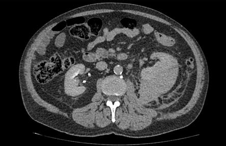 A 70-Year-Old Man with Spontaneous Renal Tumor Rupture with Perinephric Infiltration in the Retroperitoneal Space – A