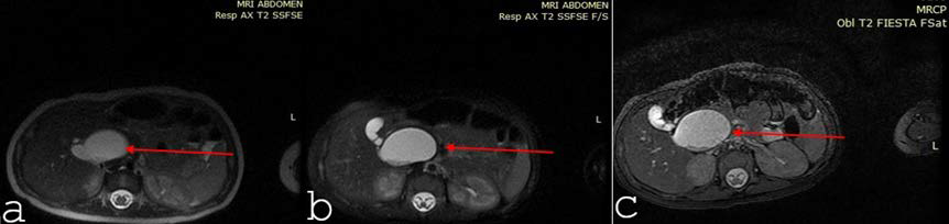 2-day old male neonate with atypical type IVA right hepatic duct cyst. Axial magnetic resonance imaging T2-weighted Single-Shot Fast Spin Echo (a) and fat saturation (b, c) images, demonstrating a 30 × 38 mm cystic lesion arising from the right hepatic duct, well differentiated from the adjacent gallbladder (red arrows).