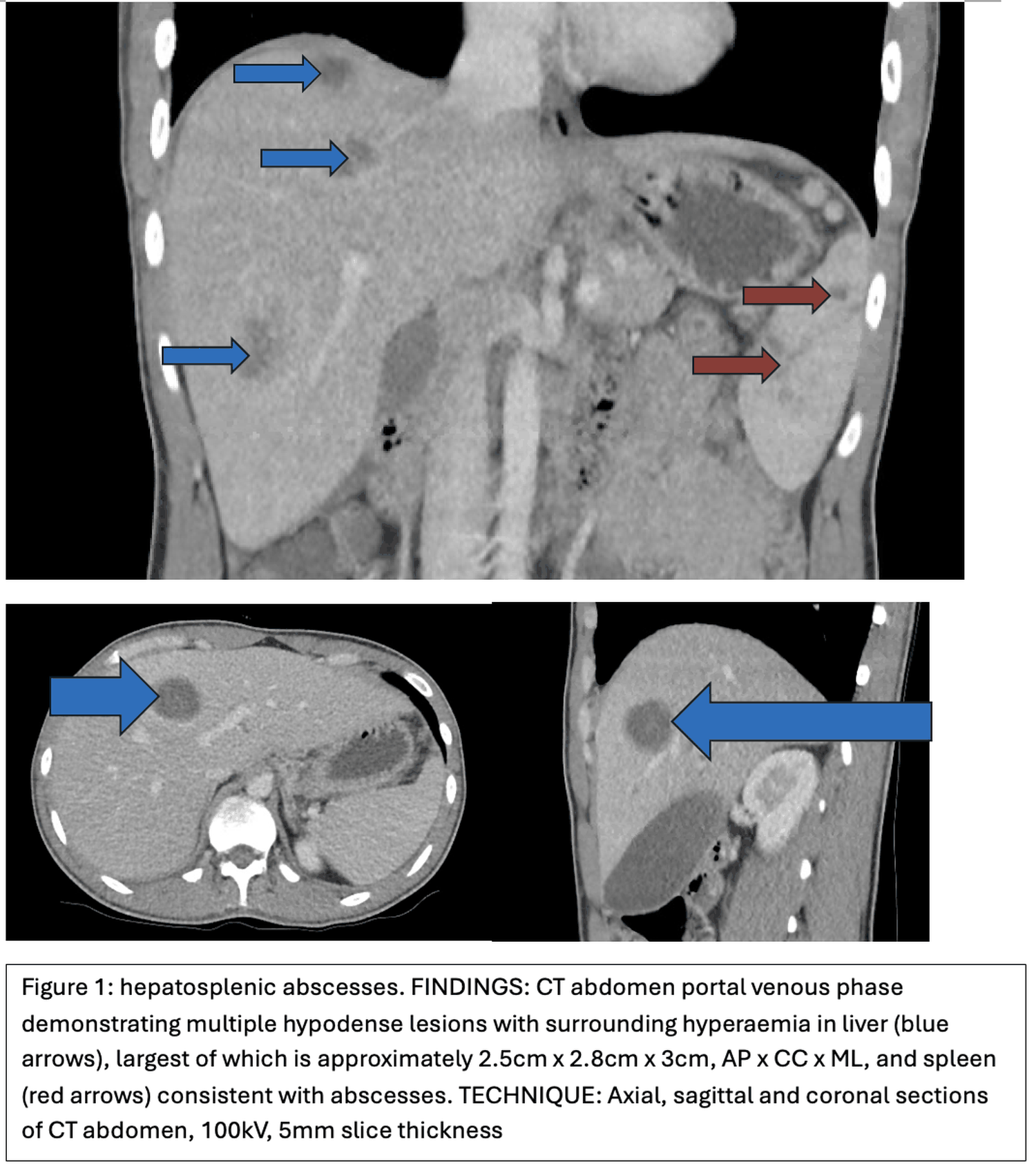 Thyroid Abscess as a Manifestation of Invasive Aspergillosis in a Chronic Granulomatous Disease Patient