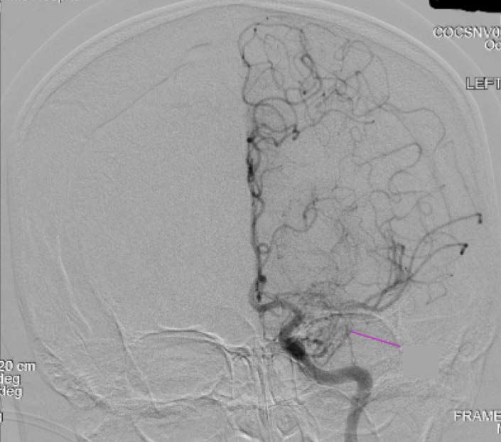 Cerebral angiography with the characteristic “puff of smoke sign” which describes the appearance of small, abnormal net-like vascular collateral networks in moyamoya disease. Occlusion of the middle cerebral artery M1 segment at its origin with extensive lenticulostriate collaterals with an angiographic appearance typical of a "puff of smoke" is visualized.