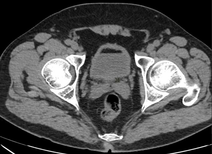 A 59-year-old male patient undergoing abdominal and pelvic CT (30/04/2024).