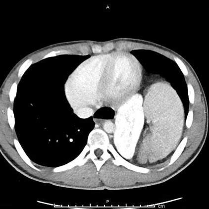 21-year-old male with left-sided Bochdalek hernia. FINDINGS: axial contrast enhanced scan showing herniated spleen and left kidney in the thorax. TECHNIQUE: Contrast-enhanced CT chest and abdomen; portal venous phases; [100kVp, 101mAs, 3mm slice thickness].