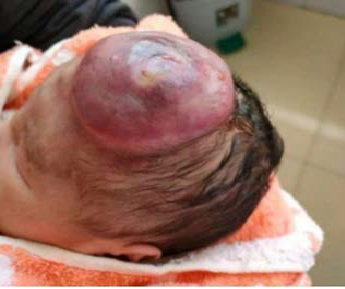 reoperative clinical photograph. A large, dark red, soft-mass lesion is visible on the left frontal region of the infant. The overlying skin is thin, with areas of slight ulceration