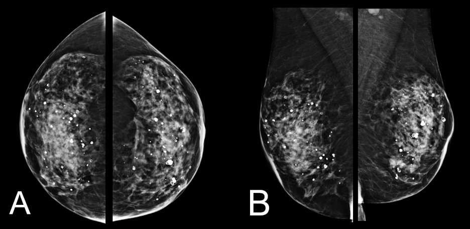 (Left) Bilateral Cranialcaudal (CC) projections of screening mammography and (Right) Bilateral Mediolateral Oblique (MLO) Projection of screening mammography demonstrating heterogenous dense fibroglandular tissue without suspicious masses, calcification, or architectural distortions. Findings are consistent with BI-RADS 1 (negative screening study) prior to the discovery of isolated axillary lymphadenopathy. Technique: Full-field 2D digital mammography with standard CC and MLO projections