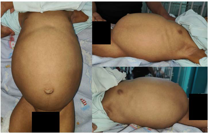 The abdomen was enlarged with a palpable mass on the umbilical region with irregular margins, smooth contour, solid consistency, and fixed to the tissue underneath.