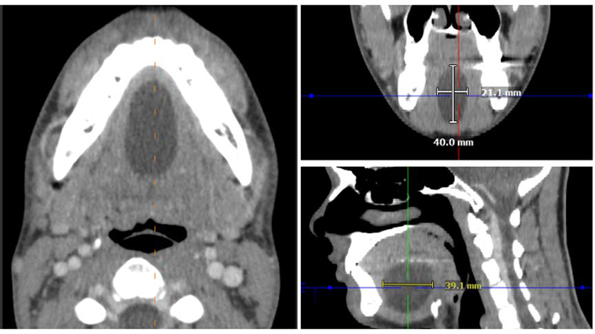 22-year-old male with epidermoid inclusion cyst in the sublingual space. FINDINGS: CT images in all 3 planes demonstrated a welldefined, homogeneously hypoattenuating, non-enhancing mass measuring 21 × 40 × 39 mm, centered in the midline anterior sublingual space between the tongue and the mylohyoid muscle. TECHNIQUE: CT neck with contrast; 146 mAs,