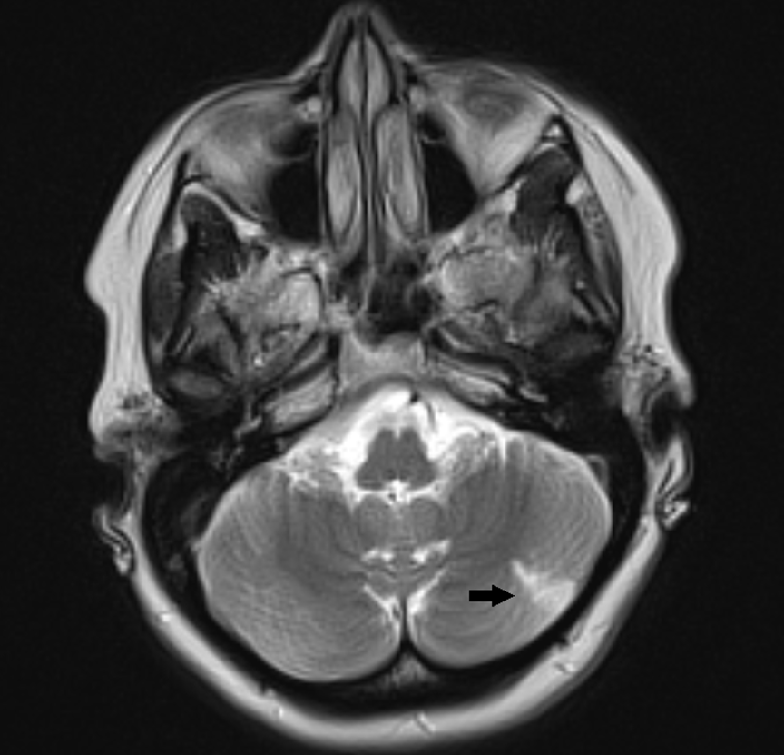 Axial T2-weighted MRI of the brain demonstrating increased signal intensity within the left cerebellum, consistent with a prior infarct (black arrow).