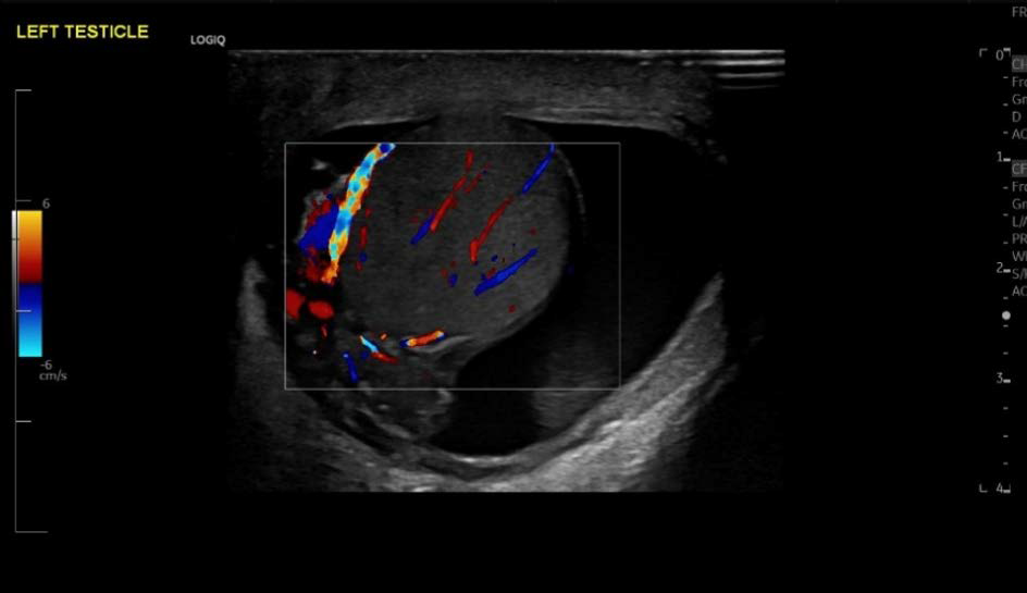 49-year-old male, Acute left-sided epididymo-orchitis