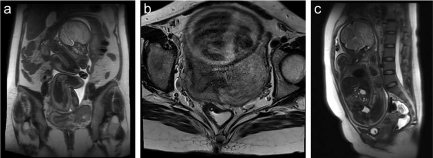 Magnetic resonance imaging (MRI) 3 Tesla, T2-weighted sequences (T2WI). The image shows the uterus located on the right side. The fetus appears superior to the uterus, suggesting an extrauterine position. The vagina and cervix are difficult to evaluate Mullerian anomaly. (a) Coronal view (b) Axial view (c) Sagital view.