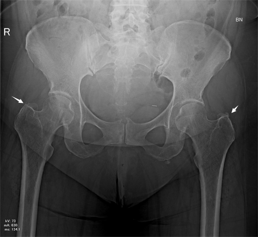 Pelvic radiograph showing calcific deposits at the gluteus medius insertion (arrows).
