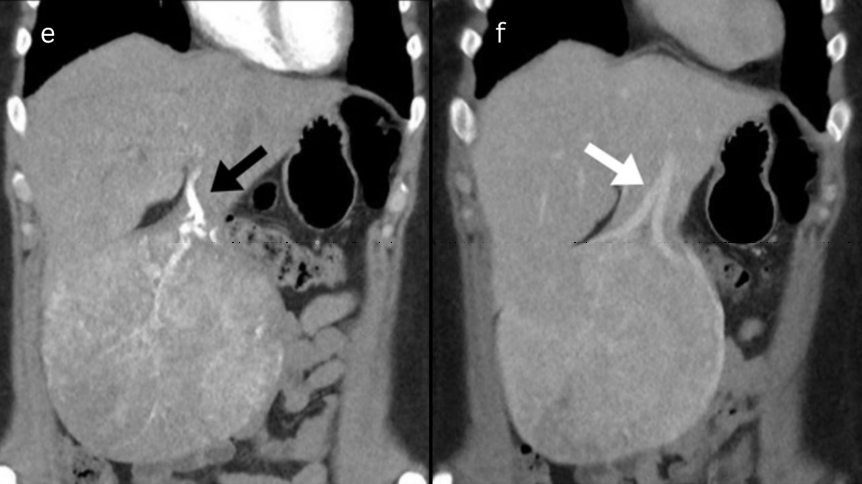 A 37-year-old female with a pedunculated hepatocellular adenoma