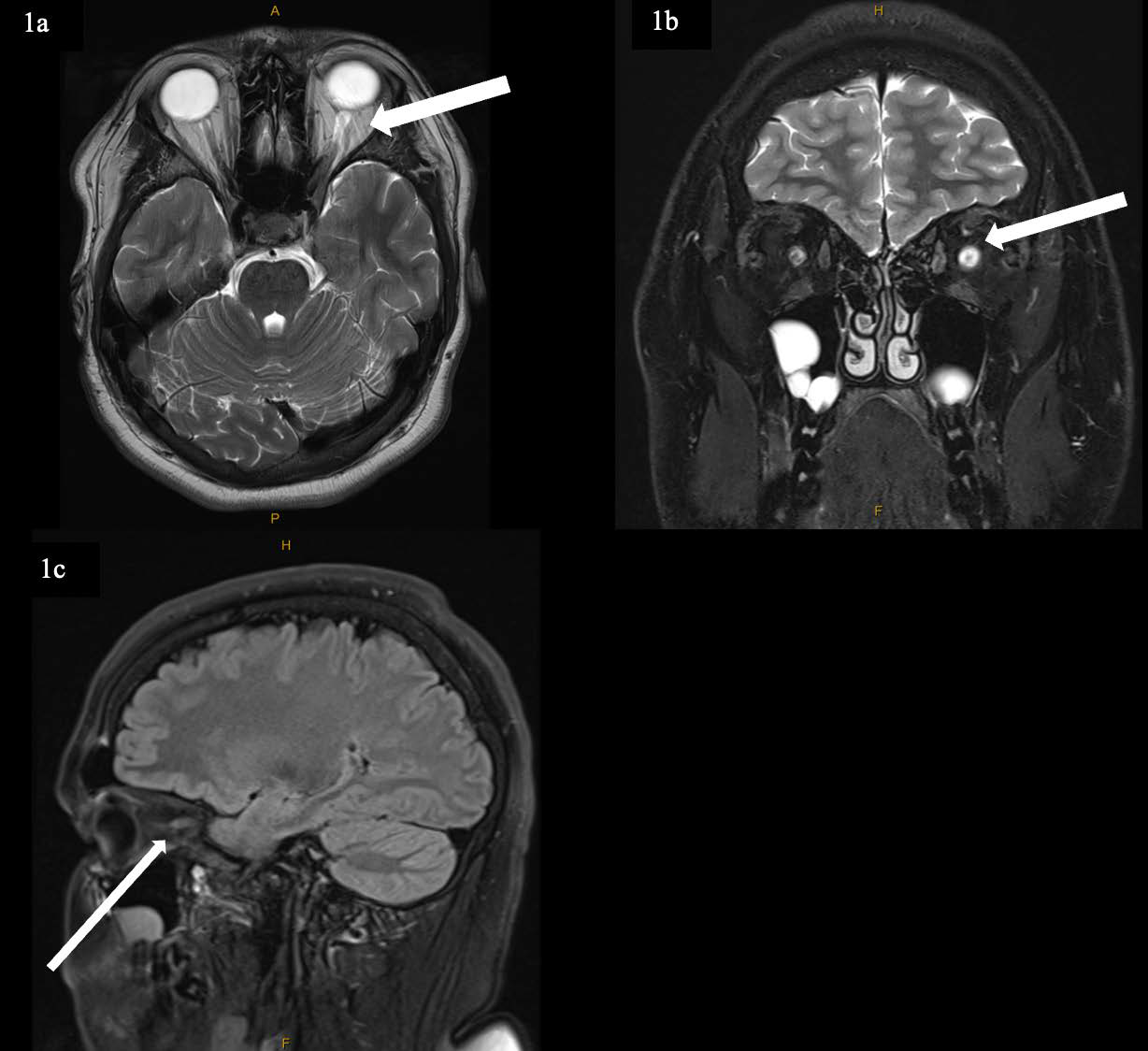 MRI Orbits (a. T2 axial view, b. T2 coronal view, c. Fluid- Attenuated Inversion Recovery (FLAIR) sagittal view)