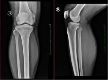 AP and lateral plain radiographs of the right knee show an avulsion fracture of the posteromedial articular surface of the proximal right tibia.