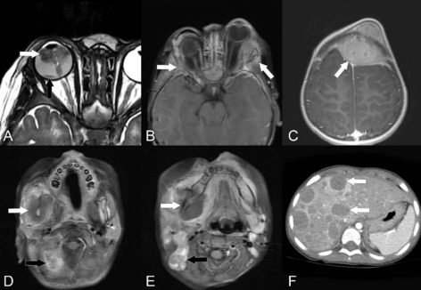 A 2-year-old male with metastatic RB to the calvarium, maxillofacial region, neck nodes, and liver. (A) Axial T2 MRI shows a hypointense mass in the vitreous of the right globe (white arrow) and a hypointense mass involving the right retina (black arrow). (B) Axial T1 post-contrast MRI shows metastases to the sphenoid bones bilaterally (arrows) with extension into the left greater than right orbit and proptosis of the left globe. (C) Axial T1 post-contrast MRI shows a left frontal calvarial metastasis with epidural extension and mass effect upon the frontal lobes (arrow). (D) Axial T1 post-contrast MRI shows a right mandible metastasis (white arrow) and a metastasis to the right occipital bone (black arrow). (E) Axial T1 post-contrast MRI shows a right mandible metastasis (white arrow) and a metastatic right upper neck node (black arrow). (F) CT abdomen with contrast shows multiple liver metastases (arrows)