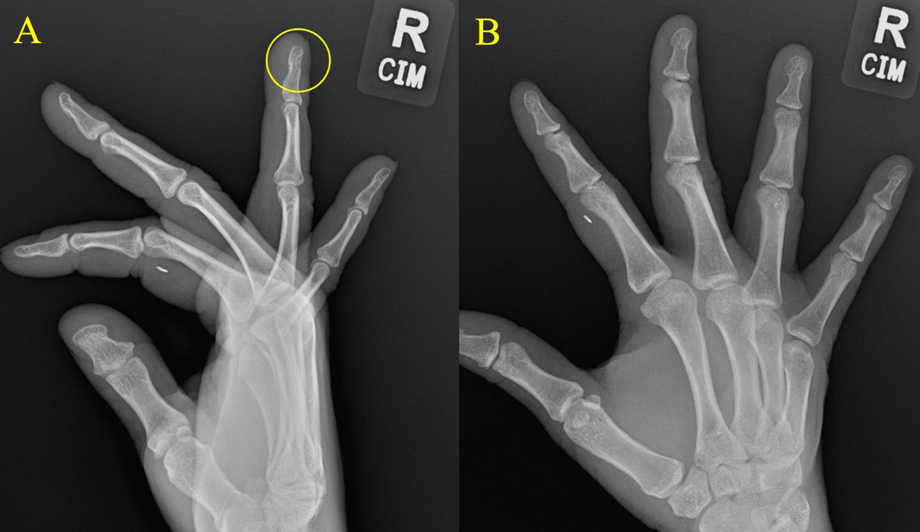 42-year-old female with glomangiomyoma