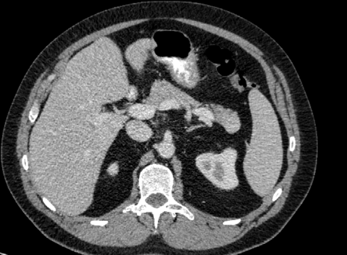 ge, Gender, Diagnosis: 54-year-old male with intrapancreatic splenunculus initially suspected to represent a pancreatic neuroendocrine tumour.